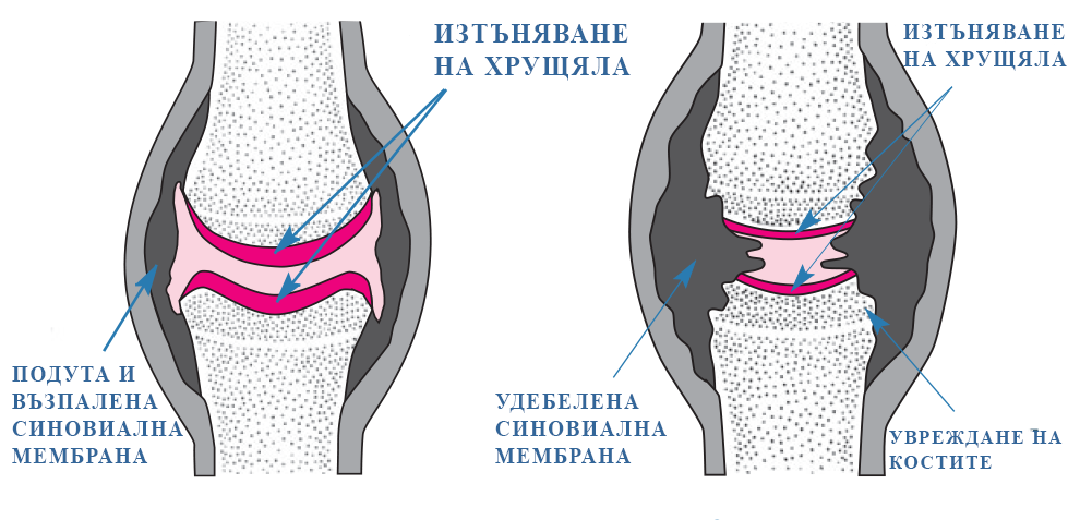 Графика - ревматоиден артрит